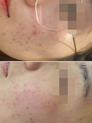 Tratamento a laser com cicatriz de acne antes