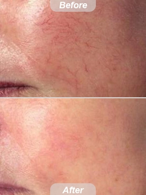 Tratamento facial do laser da veia da aranha