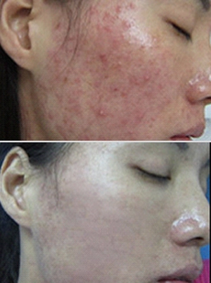 Tratamento a laser para cicatrizes de acne antes e depois