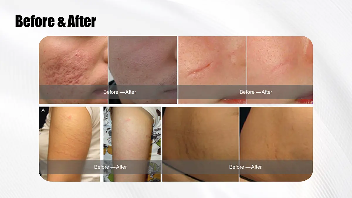 Resurfacing da pele do laser: resultados dramáticos antes e depois