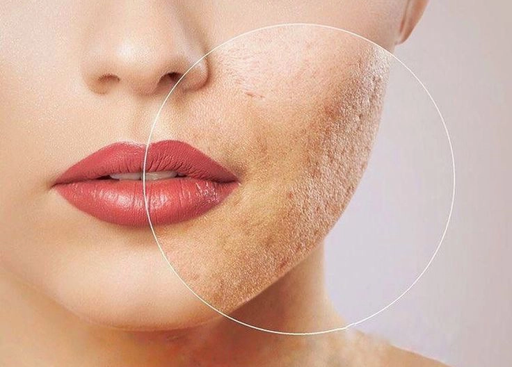 Como a máquina de vácuo vertical Microneedling RF funciona?