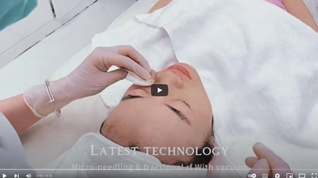 Vídeo da máquina portátil de vácuo Microneedling RF