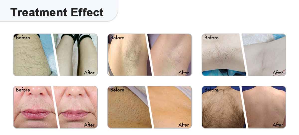 4-Wavelength Diode Hair Removal Laser Machine Effect