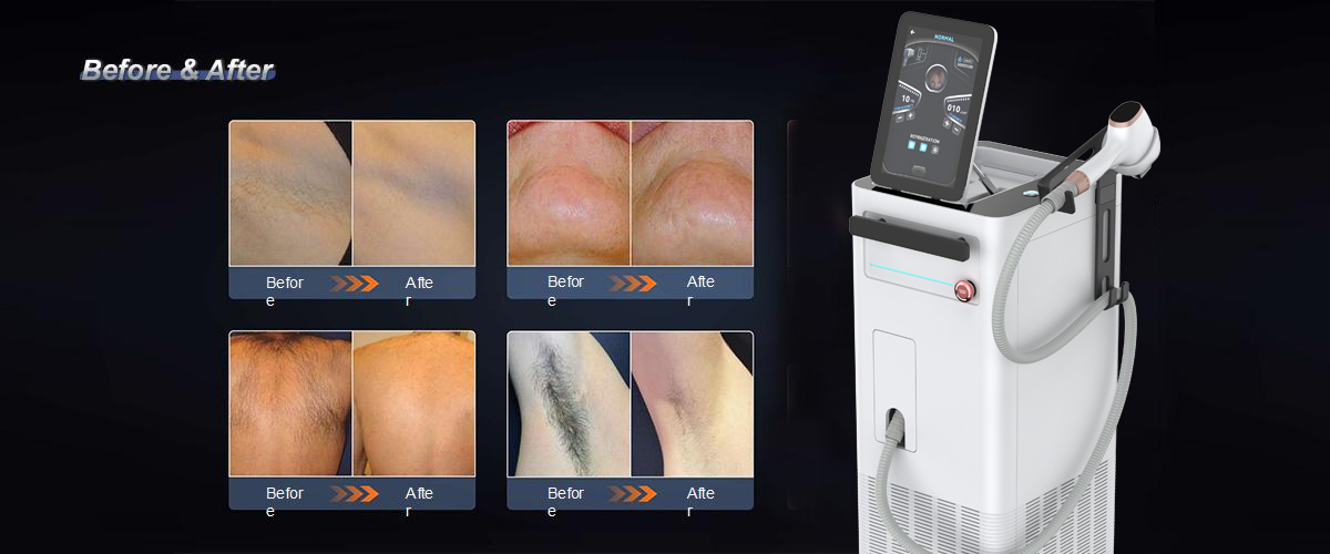 diode laser hair removal treatment