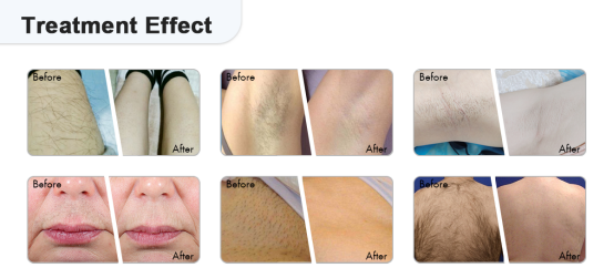 4 wave diode laser hair removal before and after