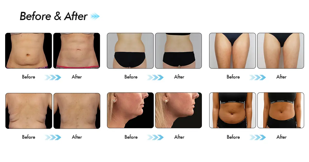 Braços superiores de CoolSculpting: fotos antes e depois