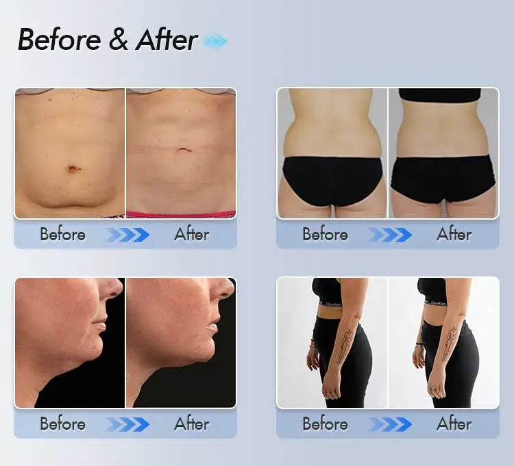 De queixo duplo a linha de mandíbula definida: coolsculpting antes e depois