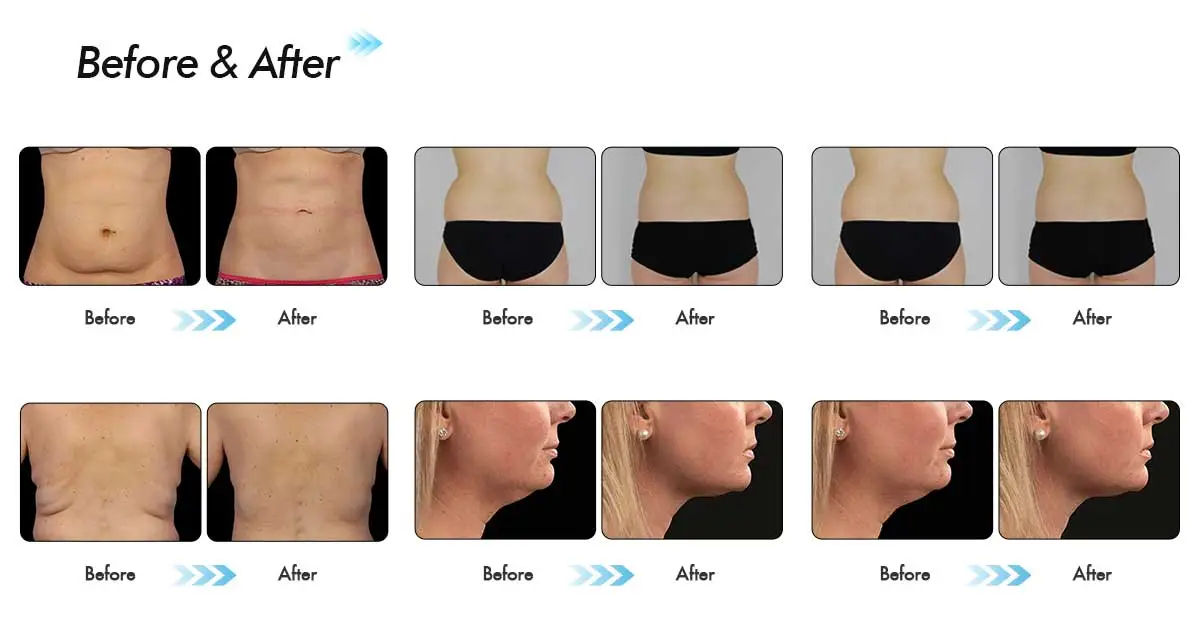 Eficácia de CoolSculpting: mudanças visuais após 1, 2 e 3 semanas