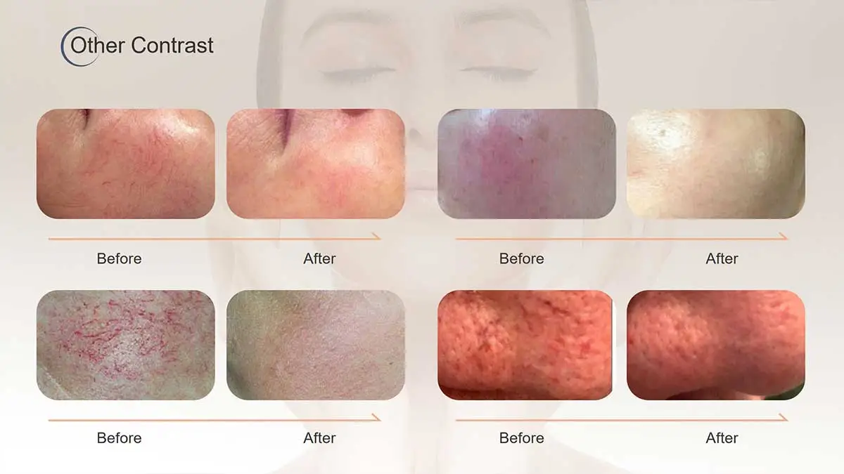 Uma clara diferença: tratamento a laser telangiectasia antes e depois