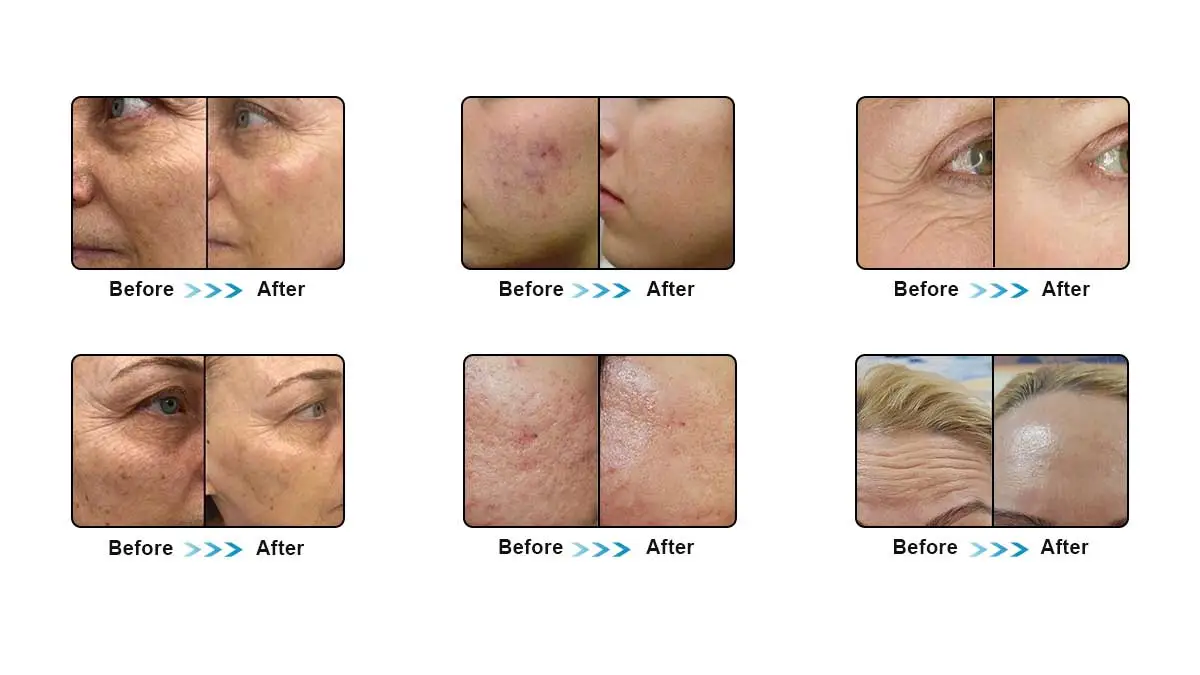 Transformação da pele com microneedling: antes e depois em todas as fases