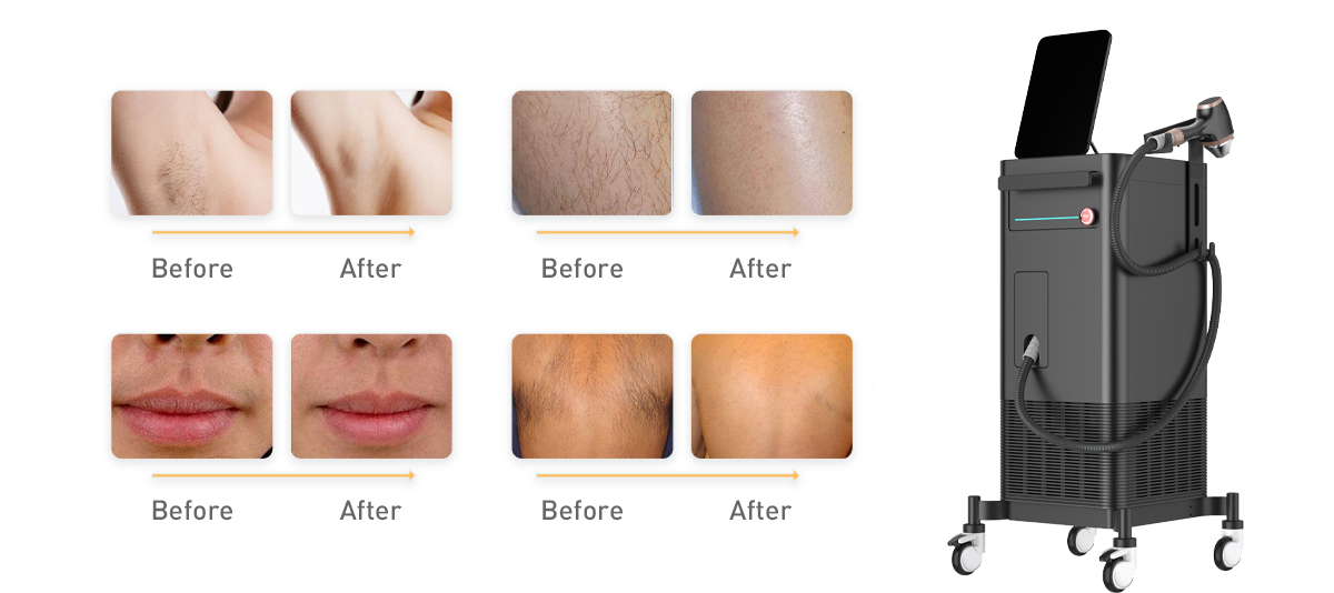 Qual método de depilação a laser é melhor?